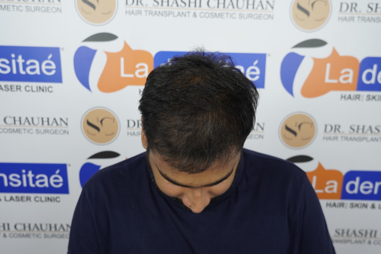 Shreyankar Maurya After Hair Transplant